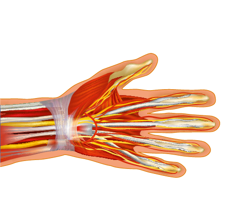 Medical illustration of carpal tunnel syndrome, highlighting compression of the median nerve as it passes through the carpal tunnel, causing numbness and tingling in the hand